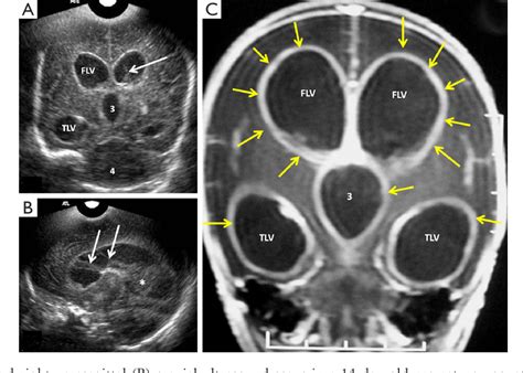 Neonatal Cranial Sonography Ultrasound Findings In Neonatal Meningitis
