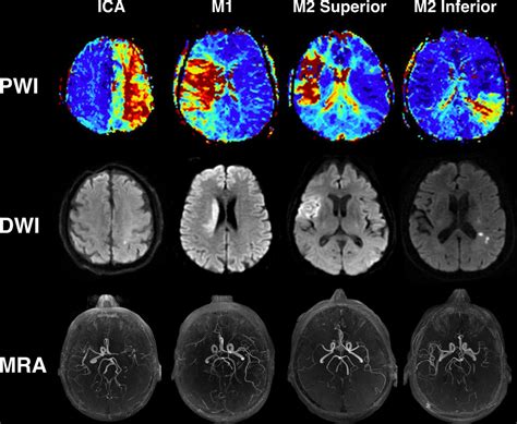 Can Diffusion And Perfusion Weighted Imaging Alone Accurately Triage