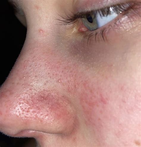 Skin Concerns How Do You Get Rid Of This Redness And These Small