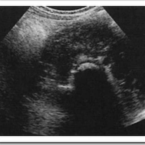 Ultrasound Images Of Horseshoe Kidneys Radiology Imaging