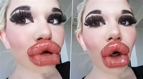 Lip Injections Gone Wrong Pics