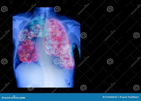 Chest X Ray Of A Patient Showing Primary Lung Cancer In Both Right And