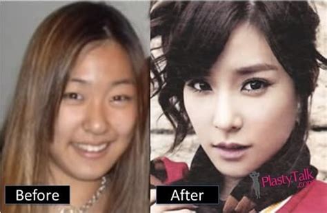Yoona Snsd Before And After Plastic Surgery Celebrity Plastic Surgery