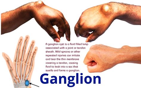 Ganglion Cyst Home Treatment Ganglion Cysts Information Florida