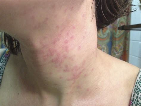 Pimple Like Dead Cells Scars In Neck