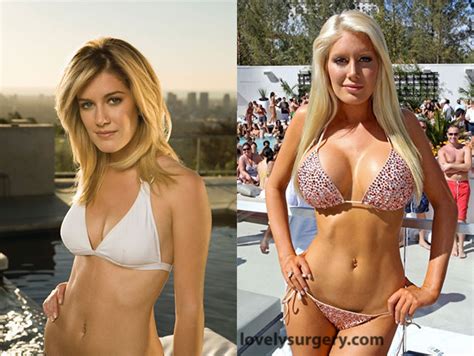 Total Transformation Of Heidi Montag Lovely Surgery Celebrity Before And After Picturer