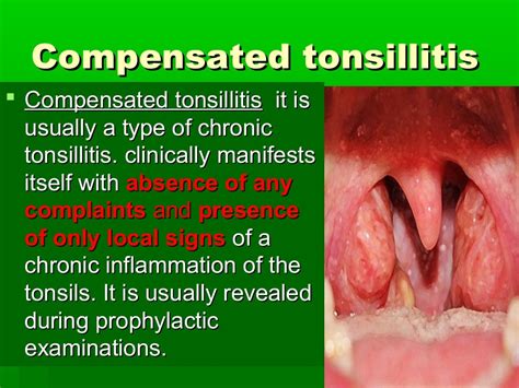 Acute Chronic Tonsillitis And Their Management