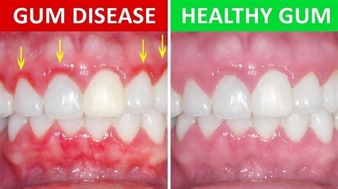 Gingivitis Vs Periodontitis What Is The Difference