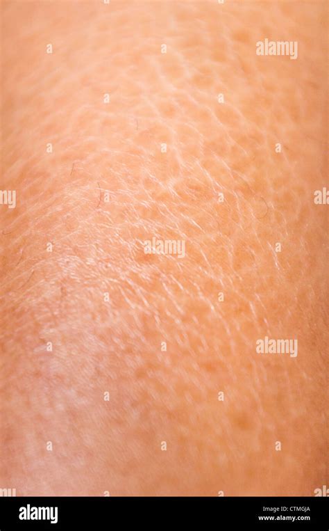 Close Up Shot Of Dry And Cracked Skin Textures On Legs Stock Photo Alamy