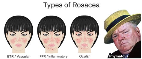 Rosacea Part 1 Types Skin By Design Dermatology And Laser Center Pa