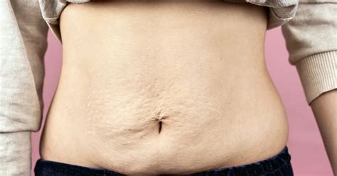 The Hidden Risk Of Liposuction Fibrosis And Its Effects Zwivel