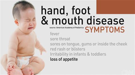 Hand Foot And Mouth Disease In Adults Symptoms And Treatment Images