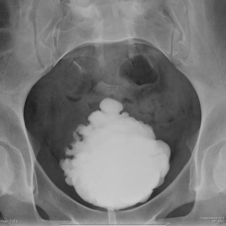 Neurogenic Bladder Radiology Reference Article Radiopaedia Org