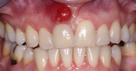 Bds Insights Dental Abscesses What Are They And How Can You Prevent