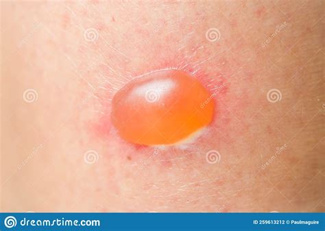 Dermatology And Skin Conditions Blister On Skin Stock Photo Image Of