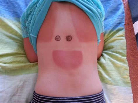 20 Funny Sunburned People Who Failed To Use Sunscreen