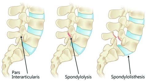 Spondylolysis And Isthmic Spondylolisthesis A Guide To Diagnosis And