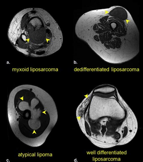 Differentiation Of Lipoma From Liposarcoma On Mri Using Texture And