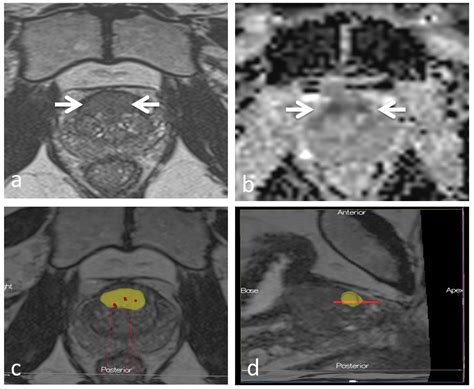 Cancer Detection Rates In Targeted Transperineal Mri Trus Elastic