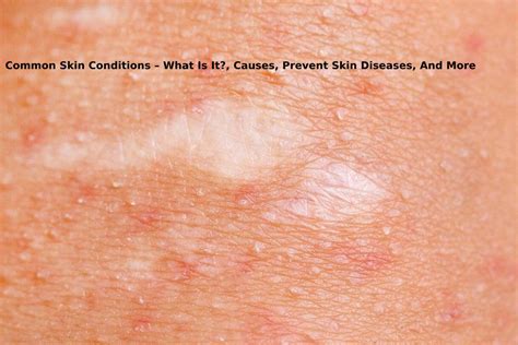 Common Skin Conditions What Is It Causes Prevent And More