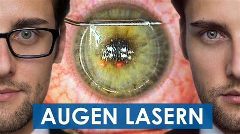 Augen Lasern Video Von Der Ganzen Operation Femto LASIK OP Teil 3