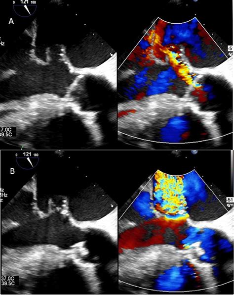 Cureus A Perforated Mitral Valve Aneurysm A Rare But Serious Complication Of Aortic Valve