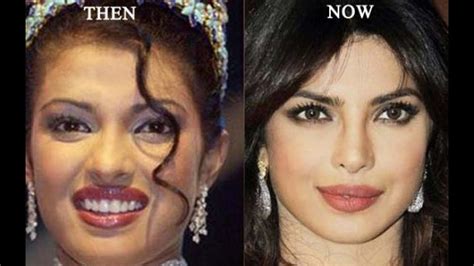 11 Top Celebrities Plastic Surgery Before And After Unseen