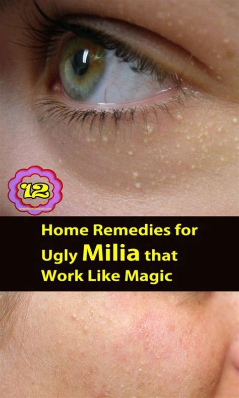 Milia Also Called Milk Spot On Skin These Tiny Facial White Bumps Can