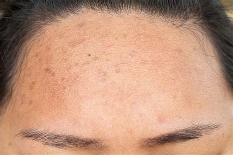Acne Scars How Do You Treat Them Arium Clinic