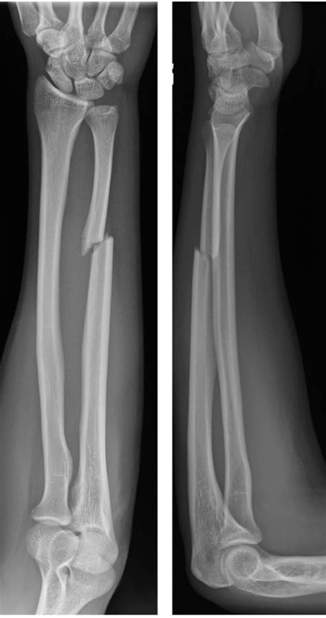 Isolated Ulnar Shaft Fracture Trauma Orthobullets Isolated Ulnar