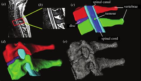 Figure From Biomechanical Modelling Of Spinal Tumour Anisotropic