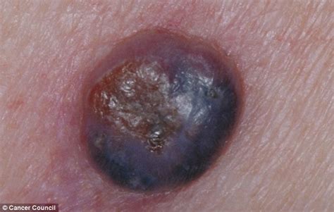 The Killer Pimple Doctors Warn Of Aggressive Form Of Skin Cancer Which Is Six Times More Likely