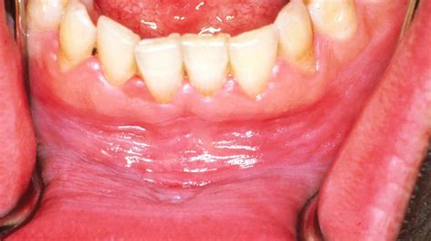 White Gums Causes Symptoms And How To Get Rid Of Them