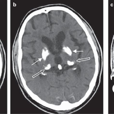 Pdf Differential Diagnosis Of Bilateral Thalamic Lesions