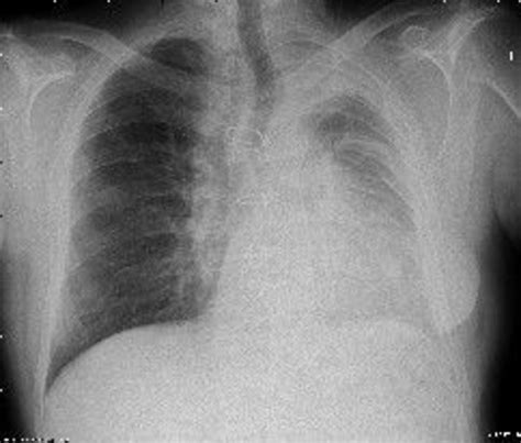 A Novel Hypothesis In Benign Pleural Thickening In Asbestos Exposed