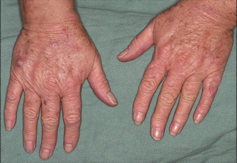 Occurrence Of Nonmelanoma Skin Cancers On The Hands After Uv Nail Light Exposure Dermatology