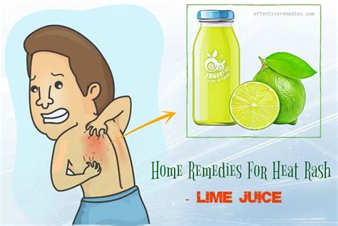 30 Best Natural Home Remedies For Heat Rash On Face And Body