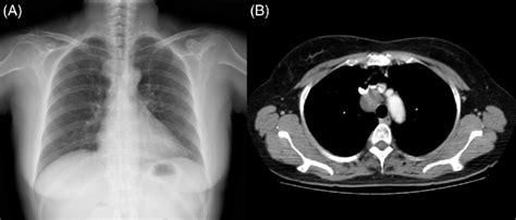 Chest Imaging A Chest X Ray Shows Right Mediastinal Enlargement B
