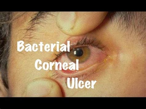 How is a corneal ulcer diagnosed? Medical Video Lecture Ophthalmology: Bacterial Corneal ...