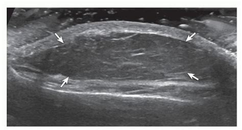 Lipoma Ultrasound Image Shows Oval Hypoechoic Subcutaneous Lipoma