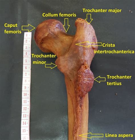 A Photograph Of The Proximal End Of A Right Femur Showing A