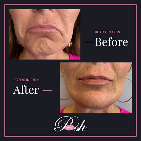 Before And After Posh Facial Esthetics