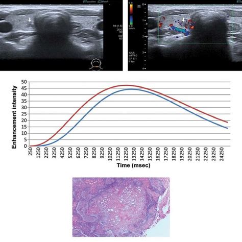 Sonograms From 2d Ultrasound Of Papillary Thyroid Microcarcinoma With