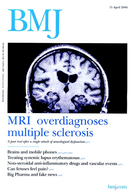 Role Of Mri In Diagnosing Multiple Sclerosis Magnetic Resonance