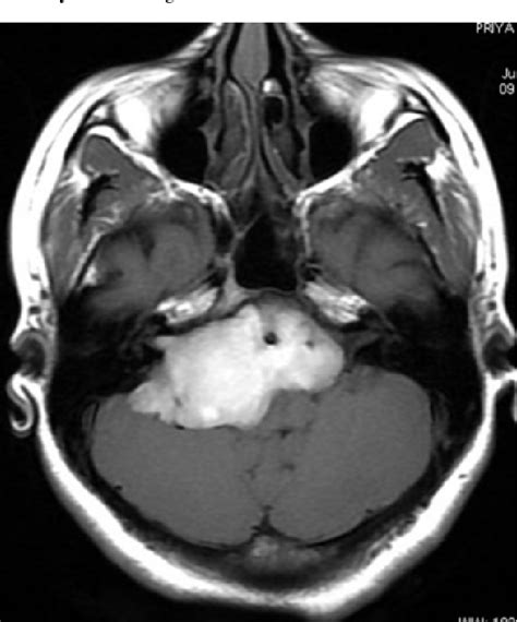 Figure 2 From Unusual Appearances Of White Epidermoid Cyst On Ct And
