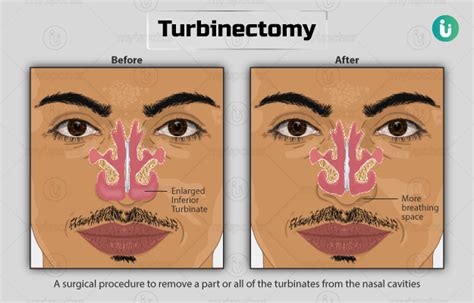 Turbinectomy Procedure Purpose Results Cost Price