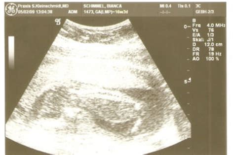 Ultraschall Ultraschallbilder Aus Dem 2 Trimester Elternde