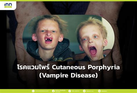 โรคแวมไพร์ Cutaneous Porphyria Vampire Disease