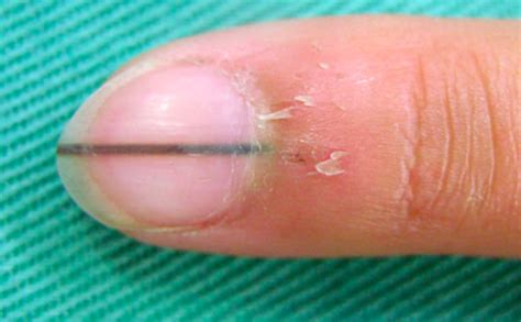 Q11爪の切り方 爪を短く切るのは良くないと言われましたが、本当ですか。 q1250歳、女性ですが、足の親指の爪が濁って、分厚くなり、曲がって生えています。 靴を履くと痛みがあります。 q13爪表面の小さい凹み 指爪の表面に小さい凹みが次々と現れてきま. 爪に短い黒い線がうっすらとある場合の治し方って？考え ...