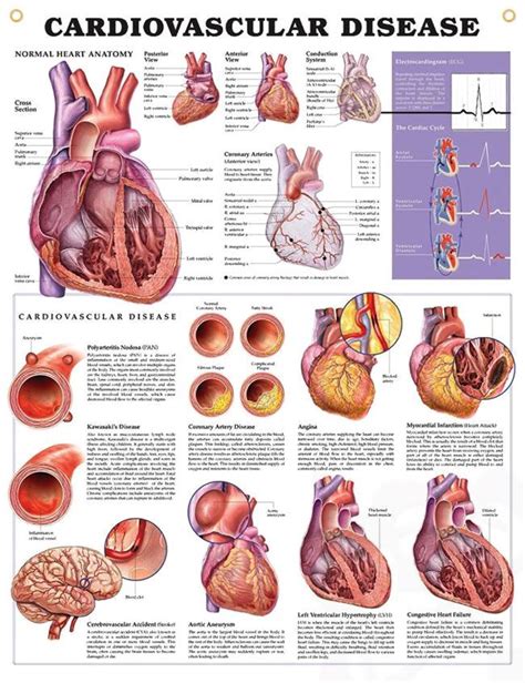 Cardiovascular Disease Anatomy Poster For Exam Room Or Classroom